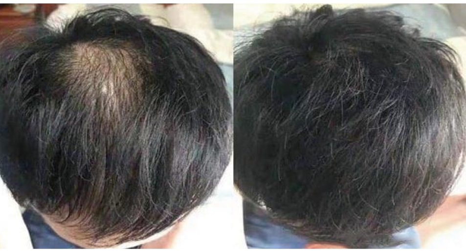 Step 4 Strengthening