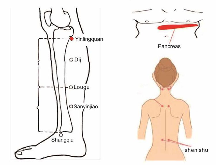 Diabetes Treatment System